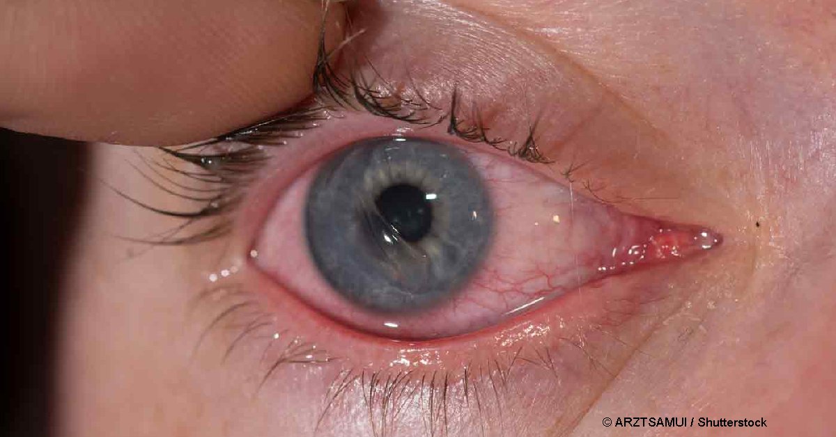 Хирурги вшили ослепшей на один глаз пациентке нерв из ноги 