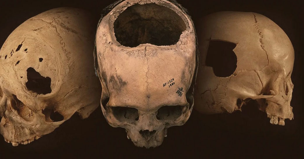 Трепанация черепа в средних веках: через неделю пациент умер