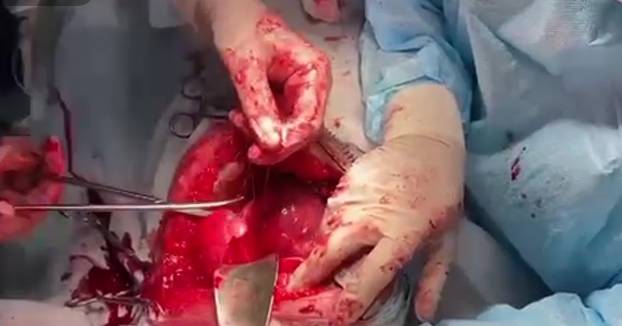 Хирург провел бойцу операцию на открытом сердце в подвале